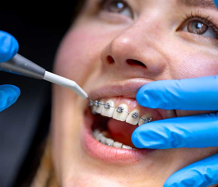 Orthodontic Treatment